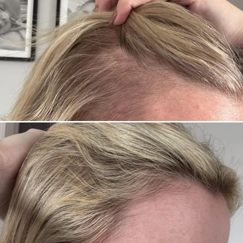 Thicker, fuller hairline — before and after